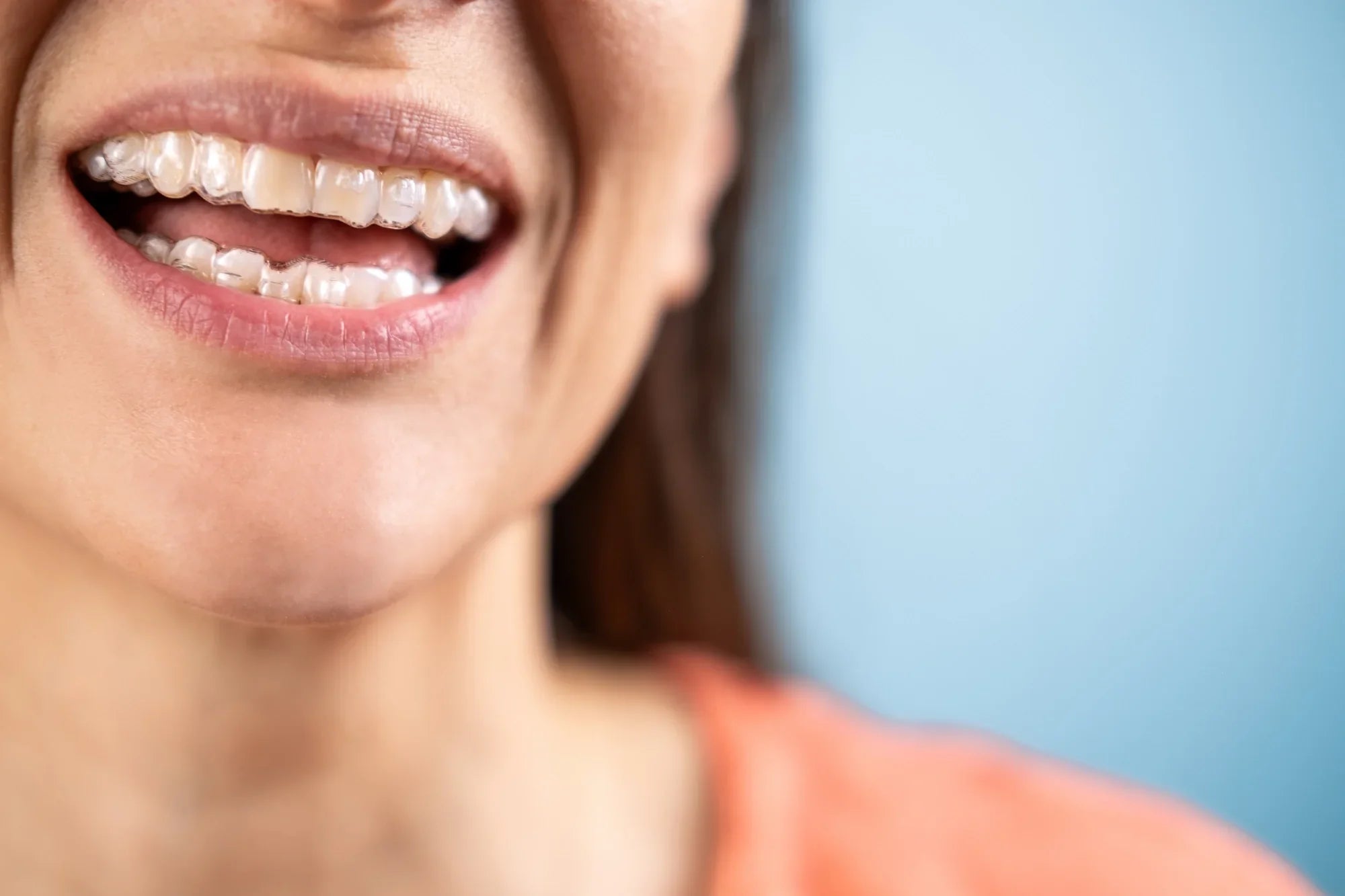 Help! Why is there build up around my teeth in aligners?