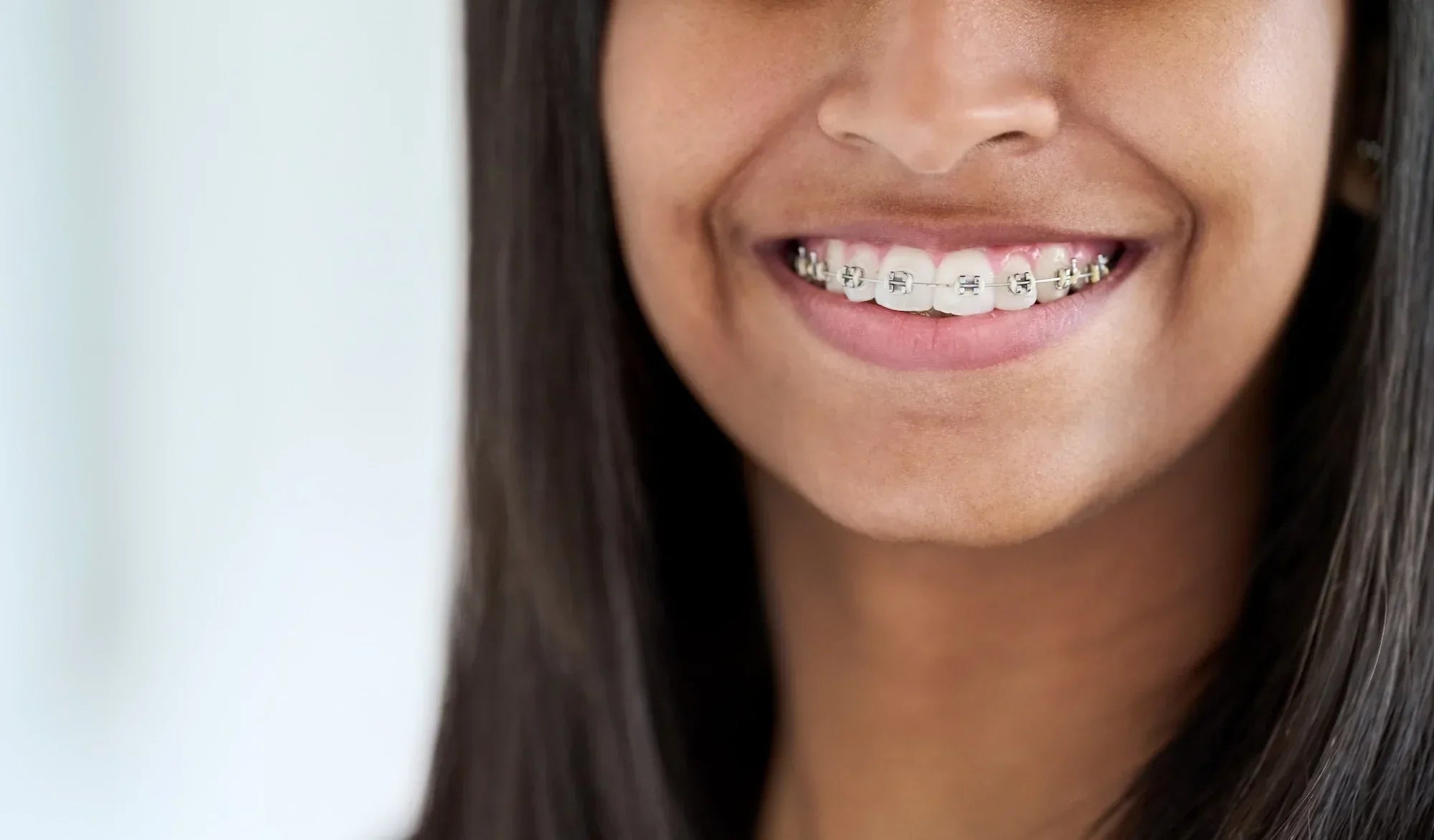 When Braces Aren’t a Pain in the Mouth