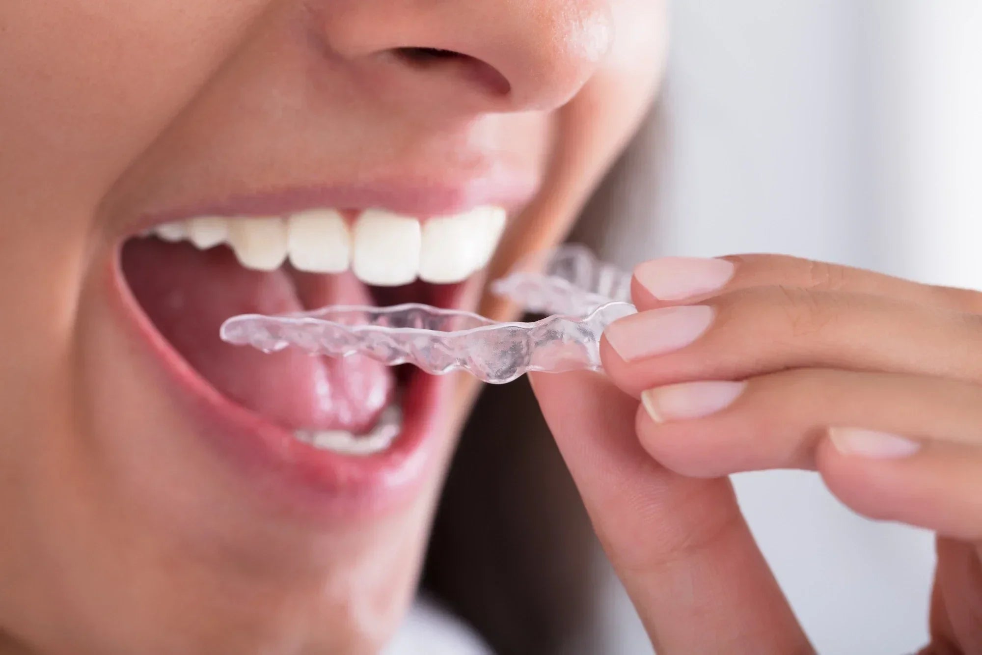 Done with braces? Top 10 First-Time Retainer Facts