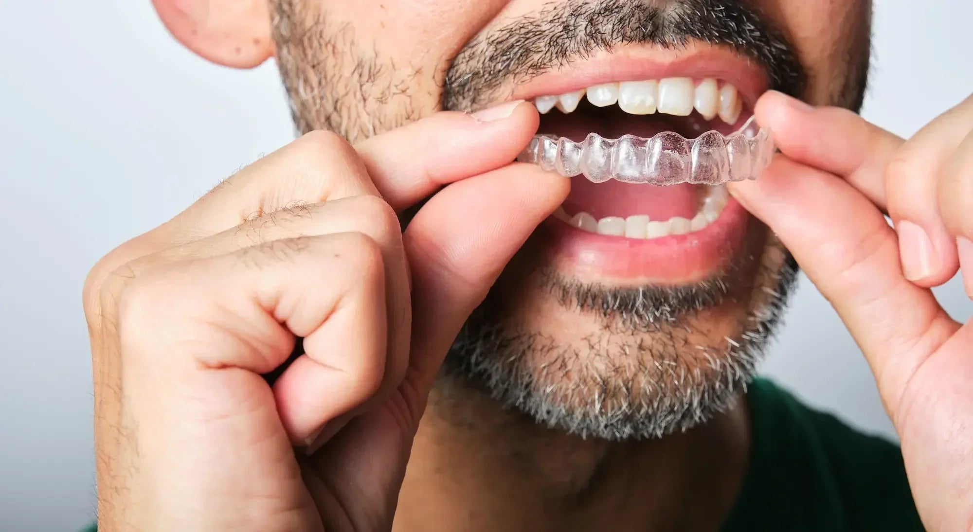 How to Heal Your Gums When Wearing Aligners