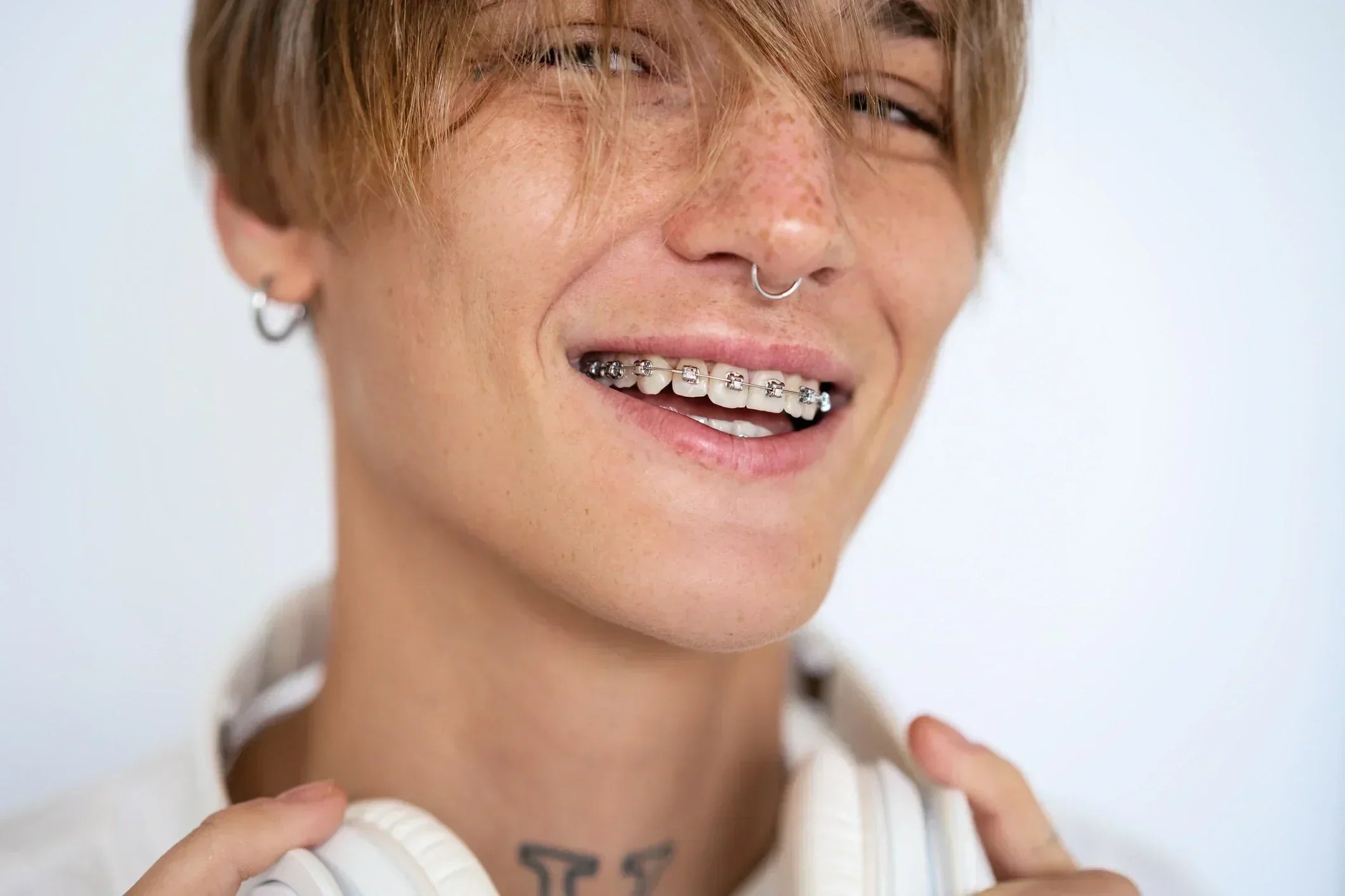 Why Are Your Teeth Moving at Different Speeds in Fixed Braces?